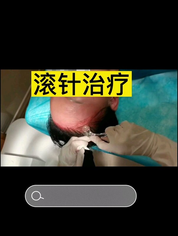斑秃脱发治愈案例
