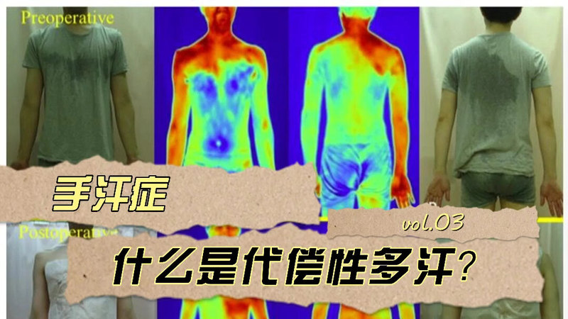 【手汗症】什么是代偿性多汗？