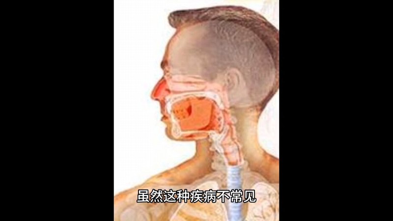 下咽癌需要哪些检查和治疗