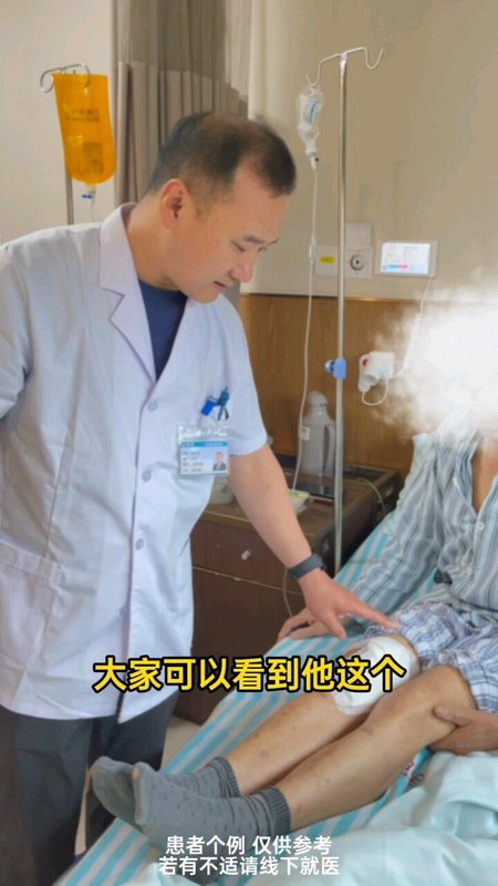 膝外翻膝关节置换2