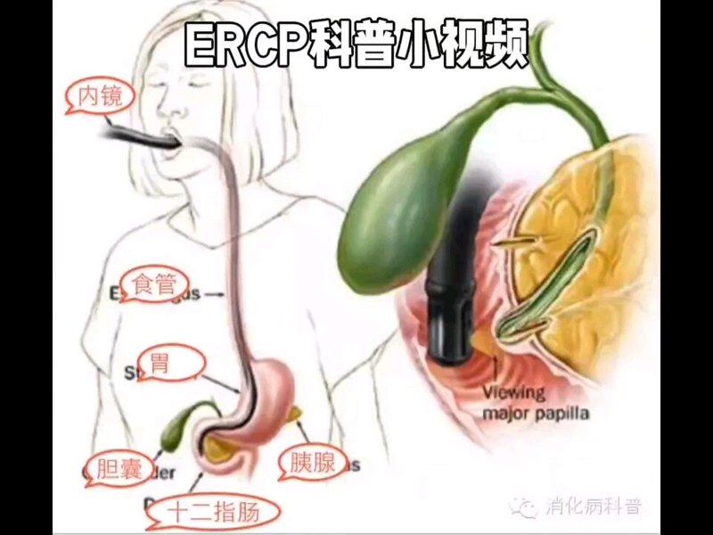 ERCP科普：