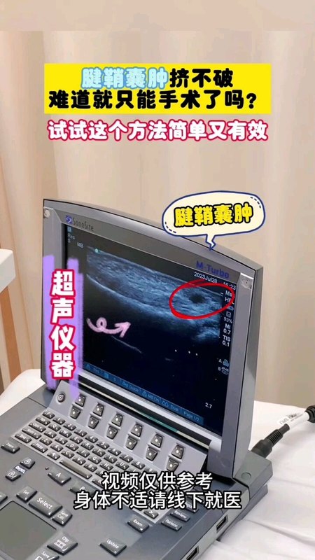 腱鞘囊肿腱鞘炎超声可视化治疗