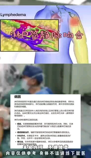 淋巴水肿淋巴管静脉吻合手术动画演示。