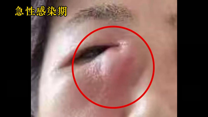 慢性泪囊炎的鼻内镜手术
