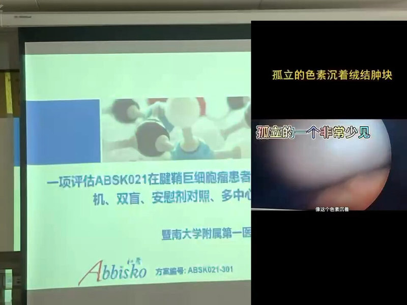 色素沉着绒毛结节性滑膜炎的关节镜微创处理