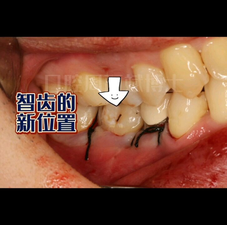 自体牙移植，以牙还牙