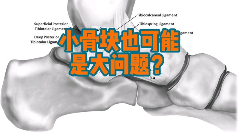 踝关节扭伤出现小骨折块，如何处理？