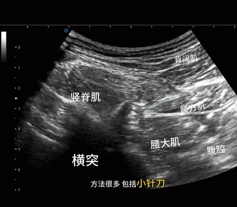 胸腰筋膜水分离可以有效改善慢性腰背痛