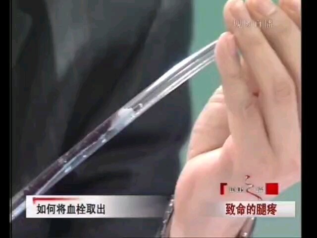 血栓最好的治疗方法就是取出血栓