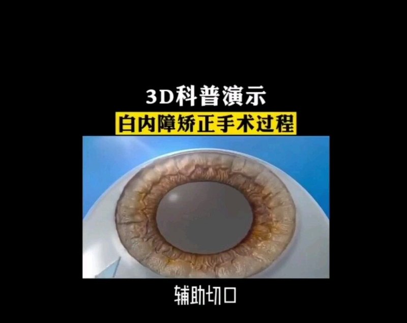 白内障手术3D演示，让你 了解白内障手术过程