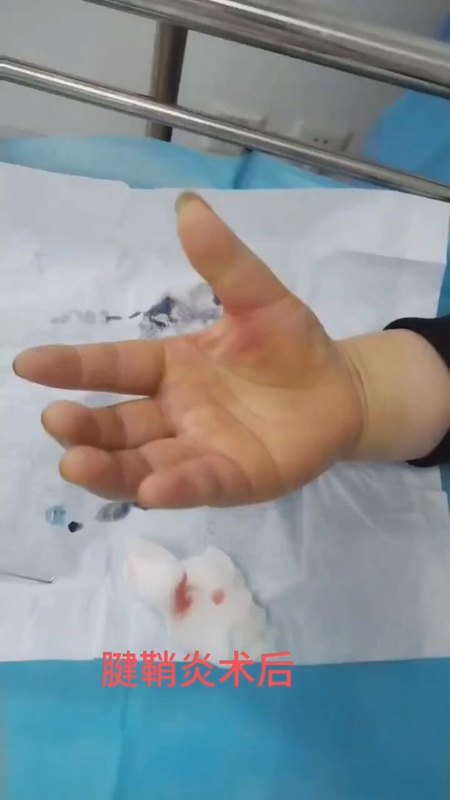 腱鞘炎的小钩针治疗，效果显著，一次性治愈！
