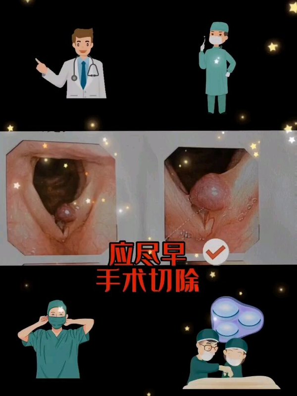 声带息肉微创手术