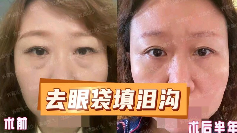 外切去眼袋填泪沟术后半年