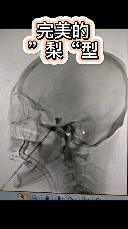 球囊压迫治疗三叉神经痛的过程