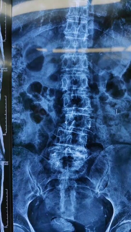 84岁椎管狭窄腰椎侧弯，微创手术