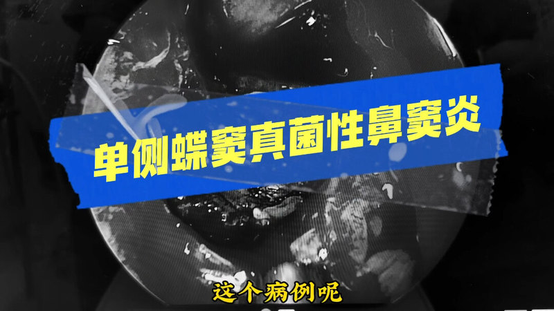 蝶窦真菌性鼻窦炎需手术治疗