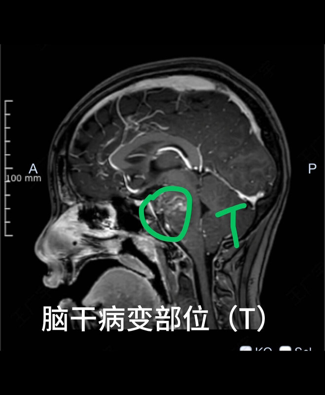 一例脑干占位（DIPG）机器人活检诊疗方案。