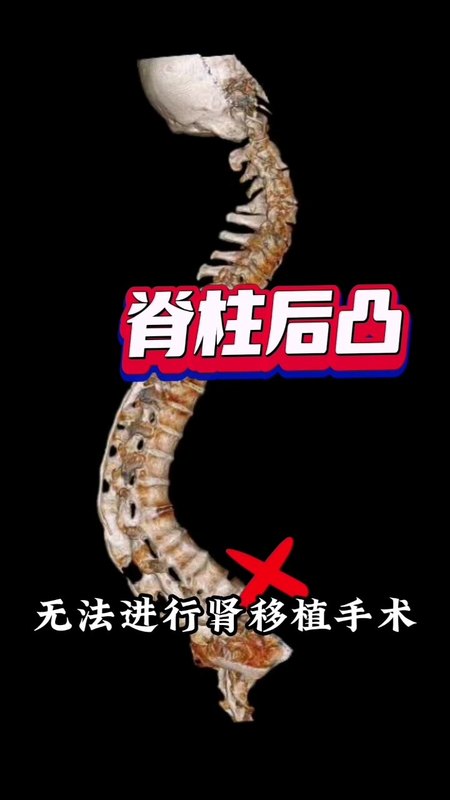 强直性脊柱炎脊柱后凸合并肾衰竭