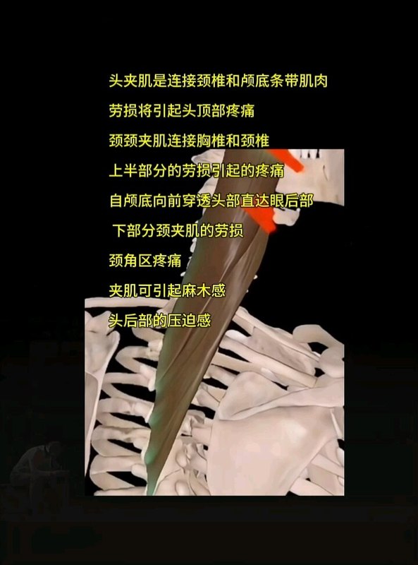 夹肌是引起头痛最常见病因，有什么特征吗？