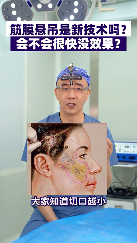 筋膜悬吊到底是什么??值不值得做
