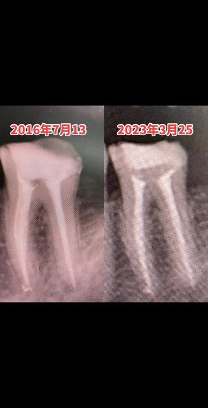根管治疗后7年间疗效稳定