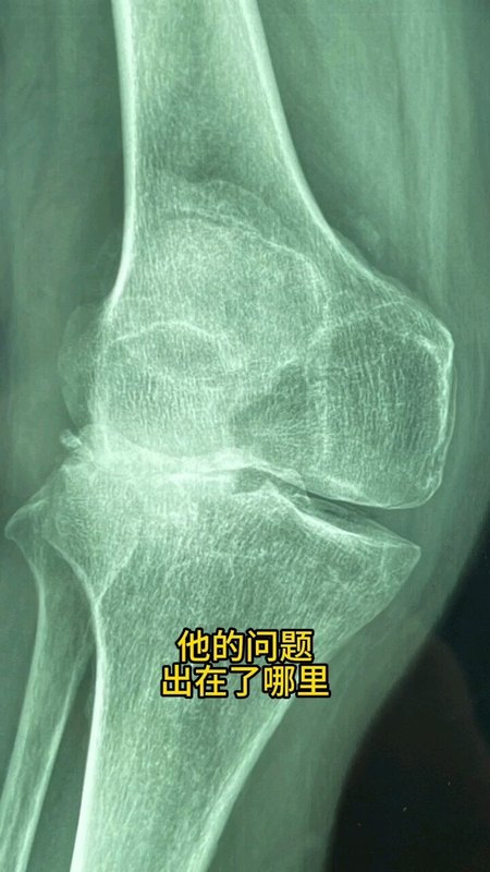 膝外翻膝关节置换1