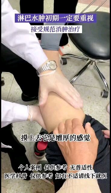 淋巴水肿初期治疗的重要性