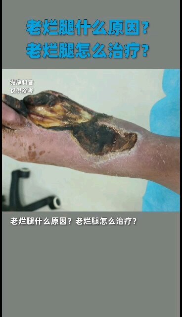 老烂腿什么原因，老烂腿怎么治疗？