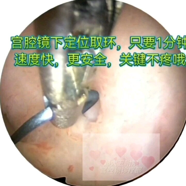 取环，宫腔镜下定位取环更快捷！更安全！更无痛！