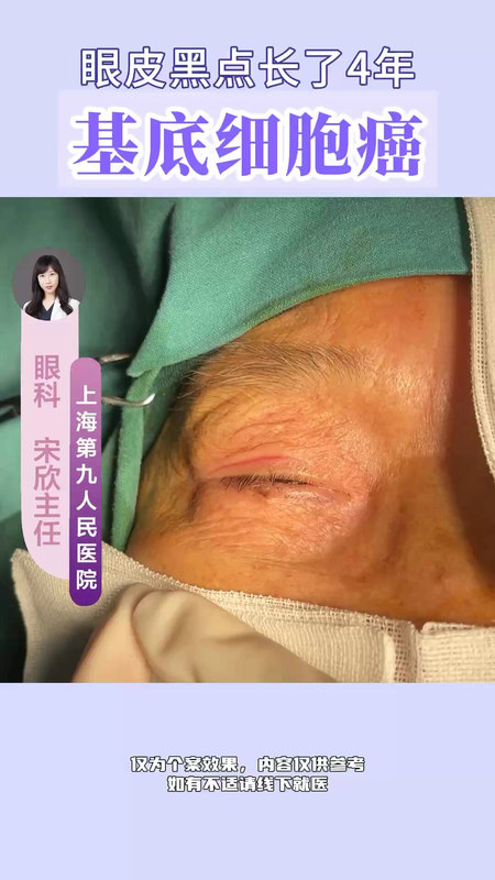 不起眼的黑痣，确是发病率最高的眼皮癌症