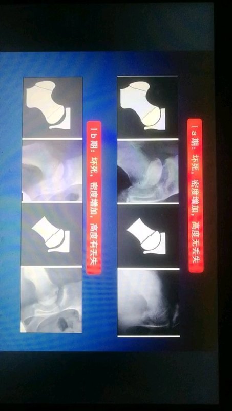 儿童股骨头坏死（perthes病）改良分期