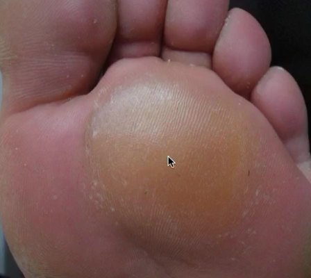 老茧（胼胝）长什么样？
