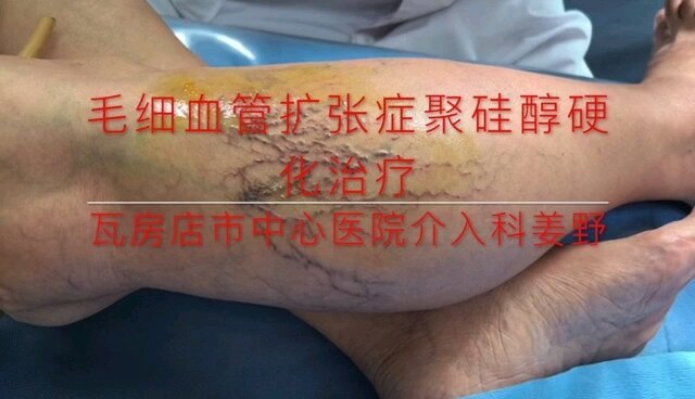 毛细血管扩张症硬化治疗