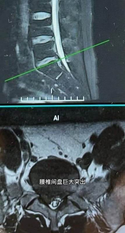 巨大腰椎间盘突出全麻UBE微创手术