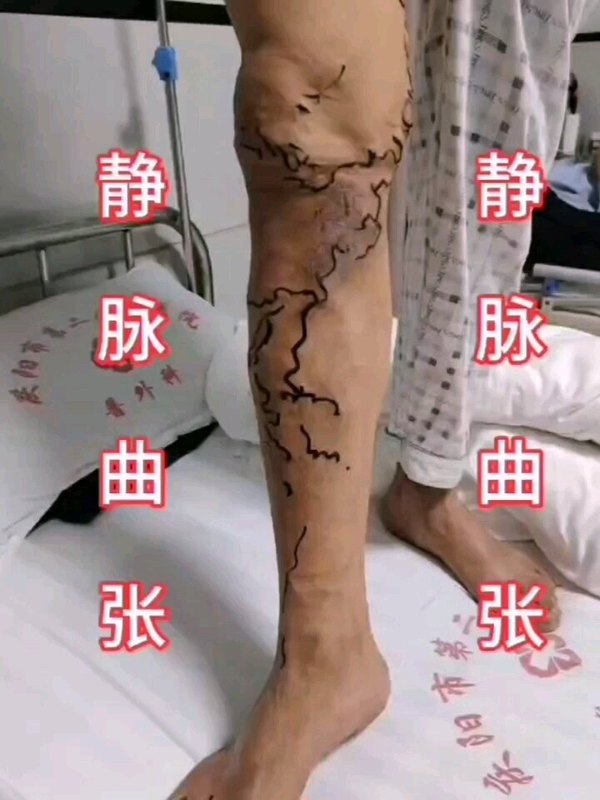 下肢静脉曲张手术科普视频