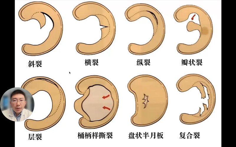 8种半月板损伤类型一次看全！