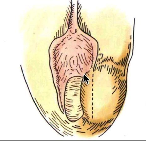 什么是巴氏腺囊肿？什么是前庭大腺脓肿？