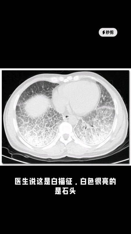 肺里有石头是什么病