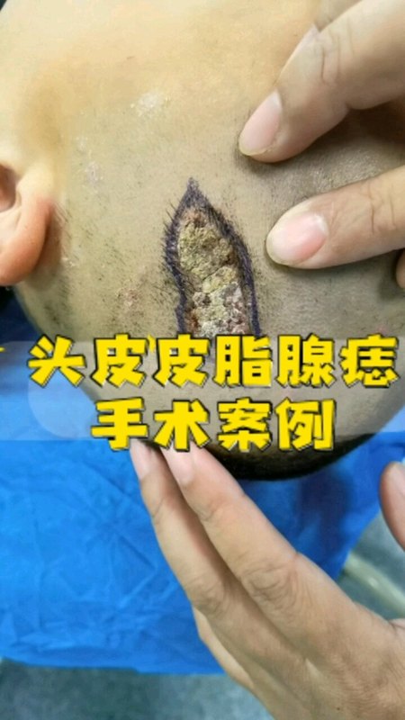 头皮皮脂腺痣手术案例