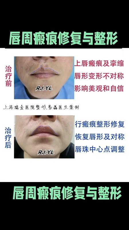 嘴唇及周围疤痕的整形修复