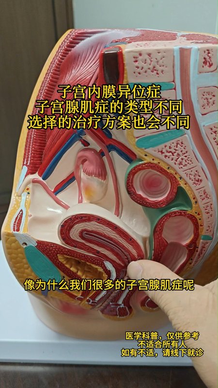 子宫内膜异位症