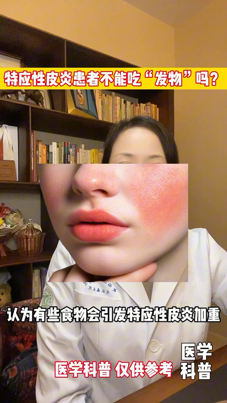 特应性皮炎患者不能吃“发物”吗？