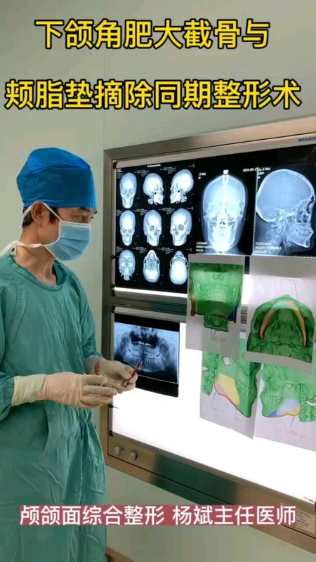 下颌角肥大截骨与
                    颊脂垫摘除同期整形术