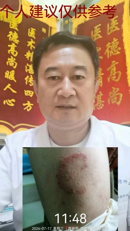 邓医生科普——体癣