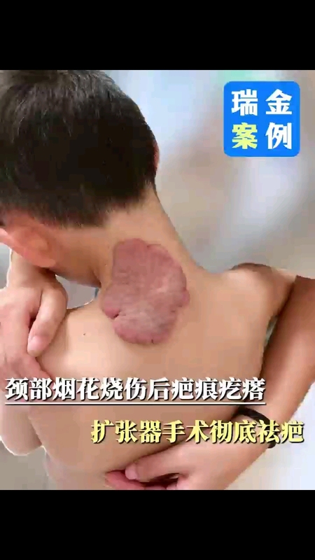 大片疤痕疙瘩手术修复，扩张器手术祛疤