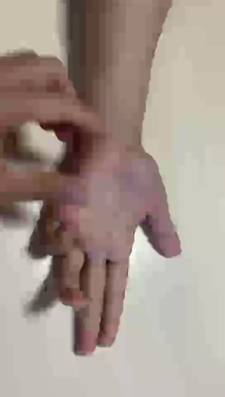 手指肌肉挛缩，是怎样的表现，要如何治疗，来看看吧