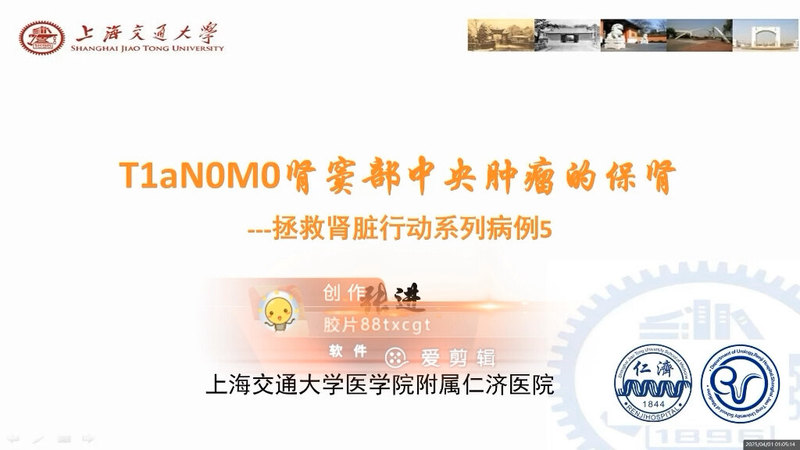 T1a期肾窦部肿瘤达芬奇微创保肾病例