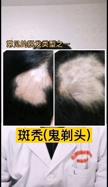 鬼剃头如何治疗