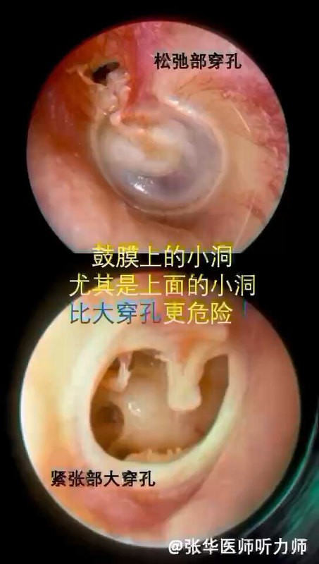 鼓膜上的小穿孔有时更危险