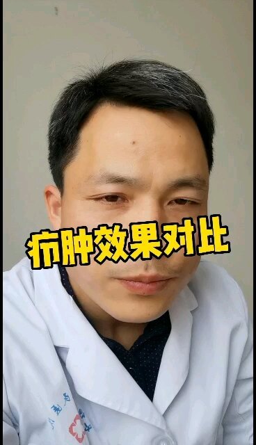 疖肿囊肿不用切除的方法，不留疤痕